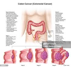 colorectal-cancer-136.jpeg