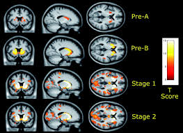 huntington-s-disease-1.jpeg