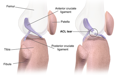 acl-injury-133.png