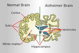 alzheimer-s-265.jpeg