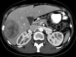 sarcoma-cancer-159.jpeg