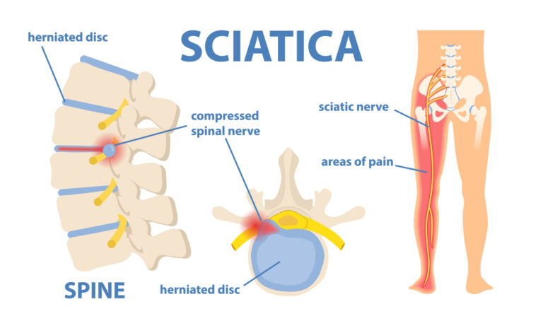 sciatica-101.jpeg