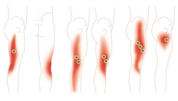 trigger-point-115.jpeg
