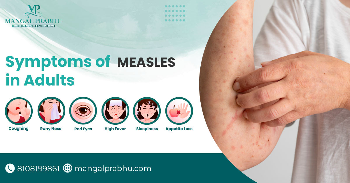 measles-symptoms-97.jpeg