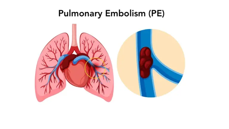 pulmonary-embolism-22.webp